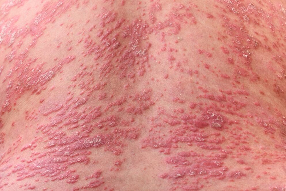 What psoriasis looks like